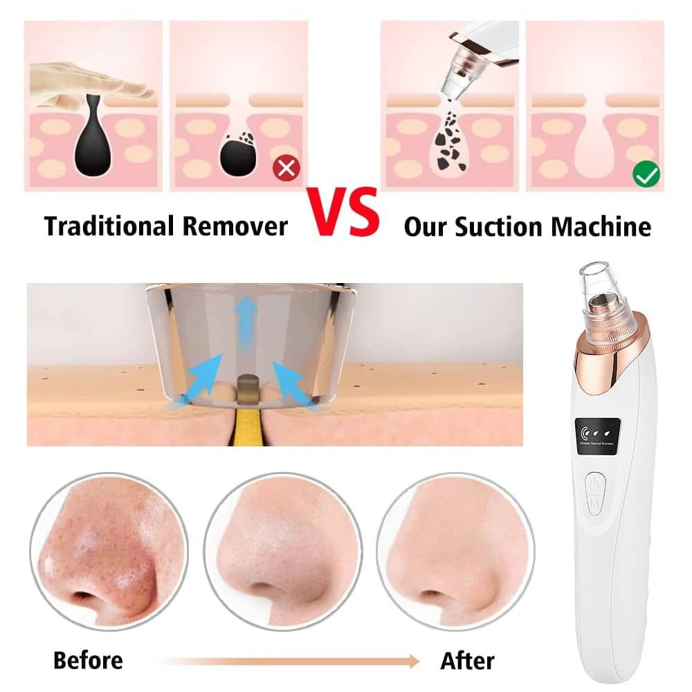 Electric Blackhead Remover  Vacuum Acne & Pore Cleaner  5 Heads Suction Machine  Skin Care & Exfoliating Tool